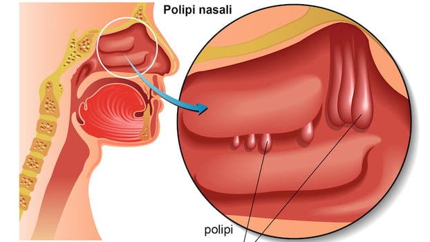 Polipi al naso? A Legnago una terapia innovativa con intervento e anticorpo monoclonale