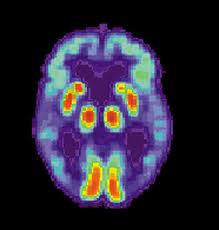 Alzheimer. Scoperto un meccanismo che fa perdere la memoria